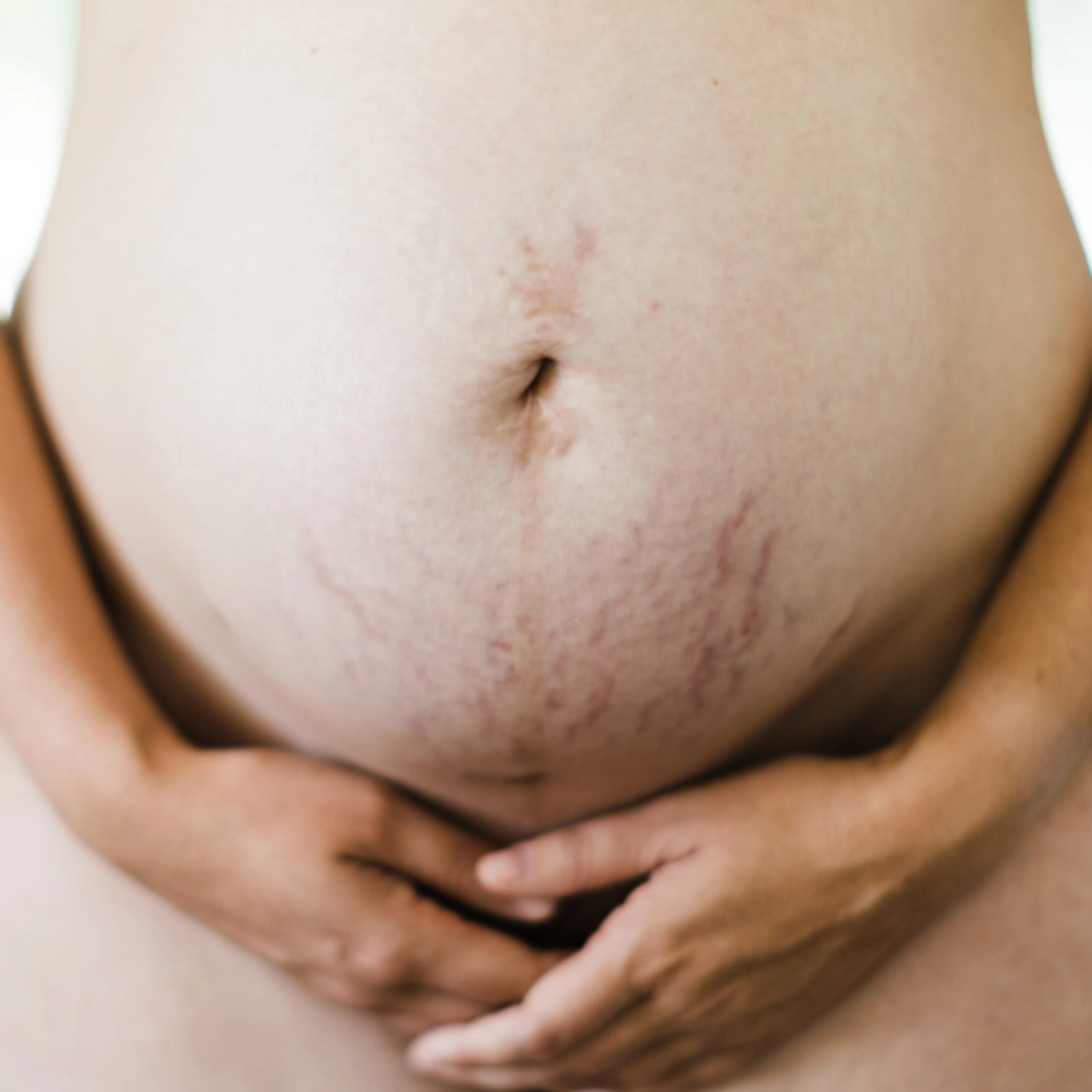 Everything You Need to Know About Stretch Marks