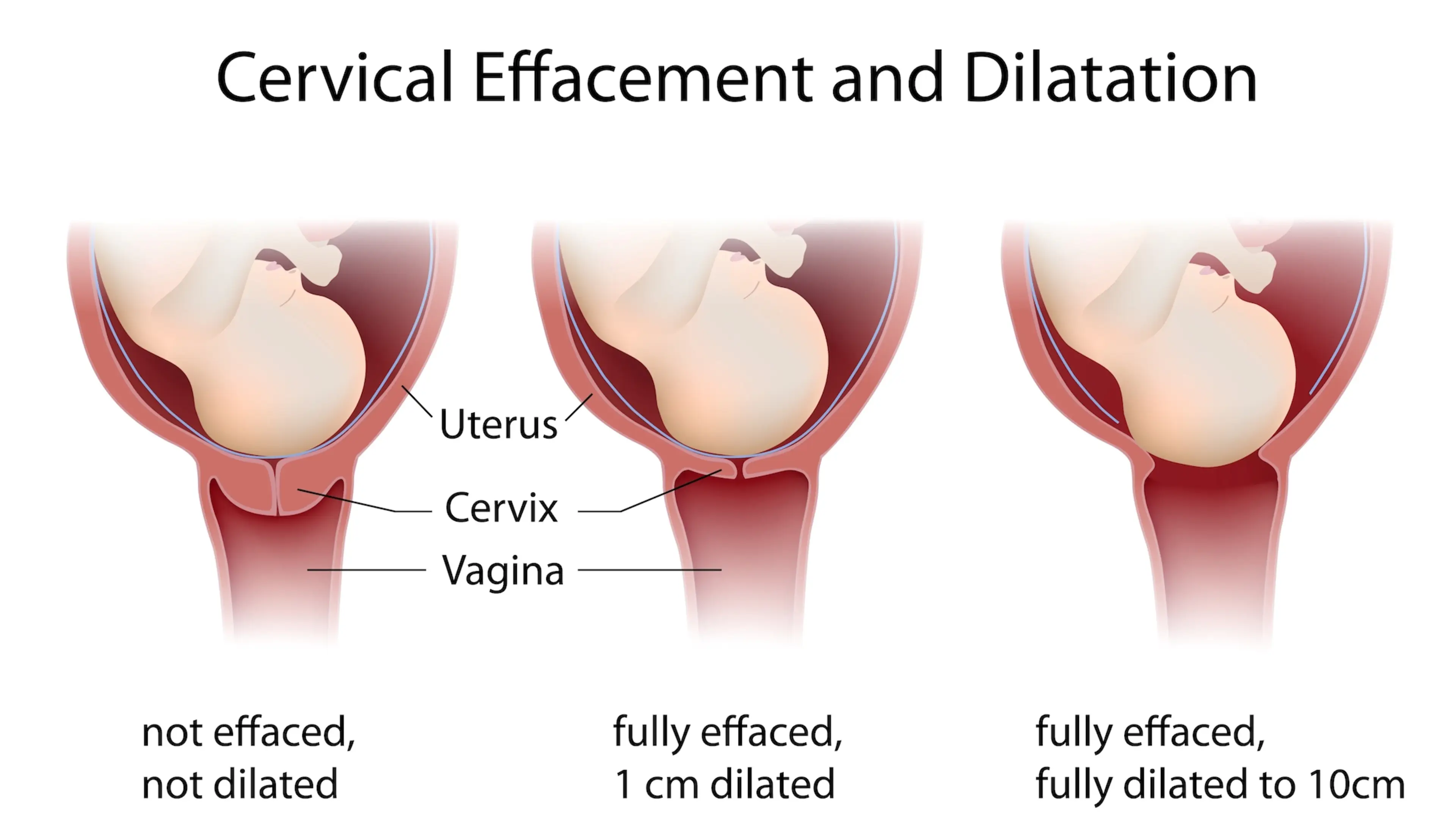 cervix not dilated, 1cm dilated and fully dilated