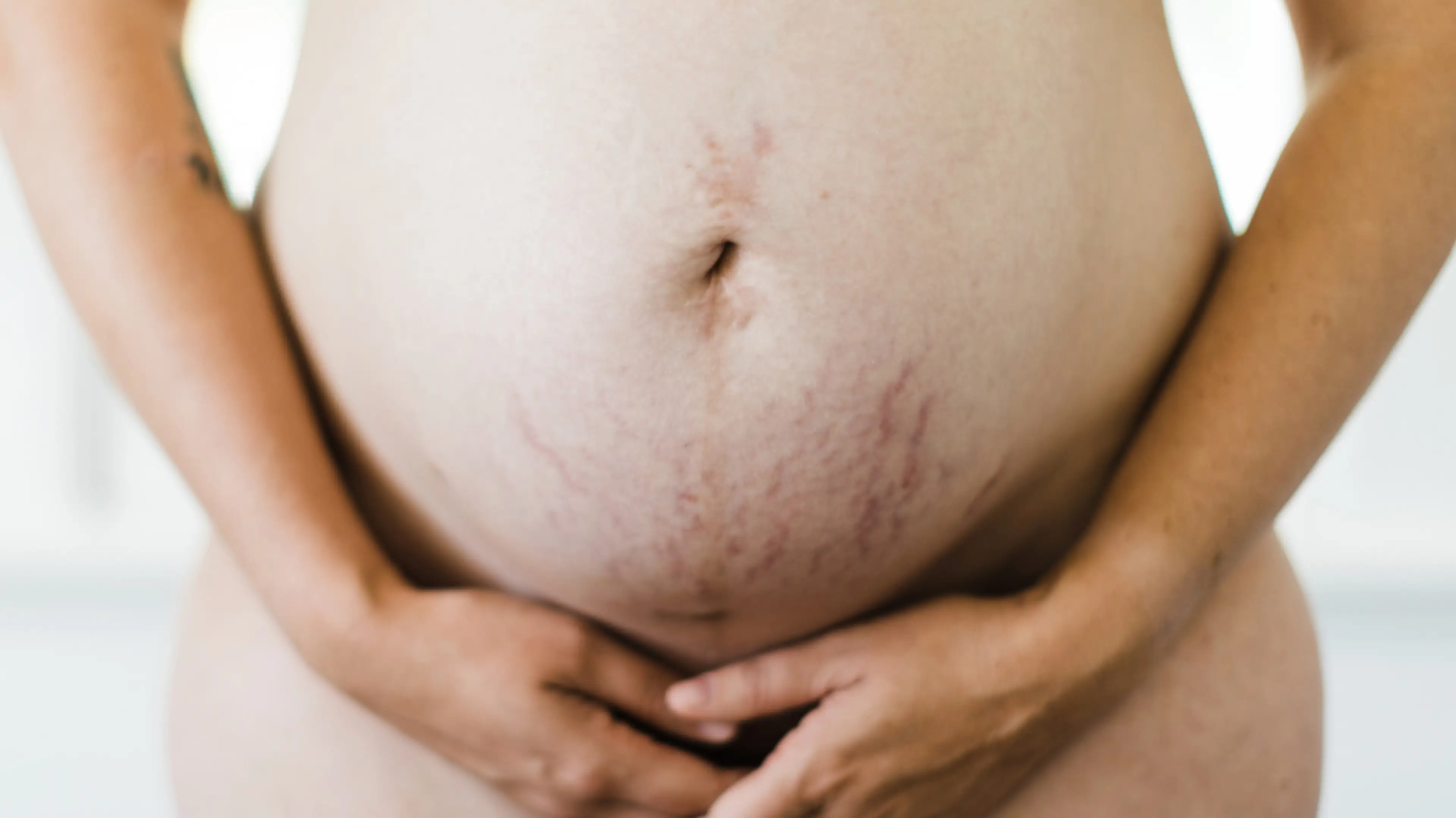 Everything You Need To Know About Stretch Marks